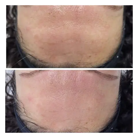 Tratament de biorevitalizare: în stânga înainte, în dreapta după