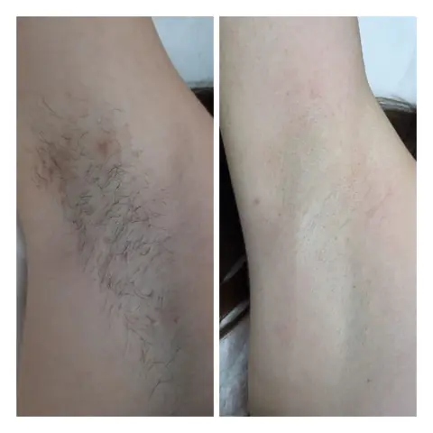 Epilare laser: în stânga înainte, în dreapta după